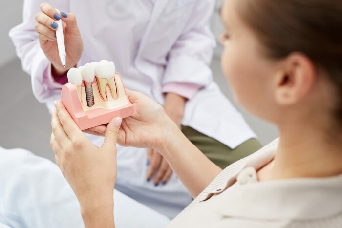 Descubra O Passo A Passo Para Realizar Um Implante Dentario Perfeito